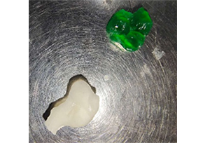 Dental casting resin is used to cast the model of teeth