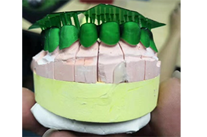 Using casting resin to make tooth crown and tooth support